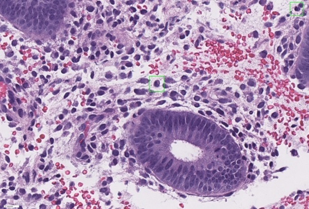Imagen: Los cuadros verdes destacan las células plasmáticas, un indicador de infección, en una muestra del tejido que recubre el útero (foto cortesía de Zou Lab y Montine Lab)